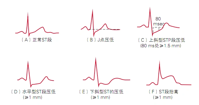 10分钟掌握标准心电图的基础知识