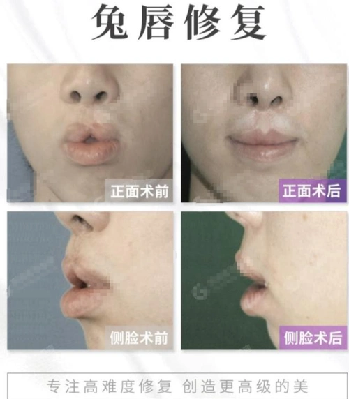 唇腭裂_唇腭裂治疗方式 - 好大夫在线