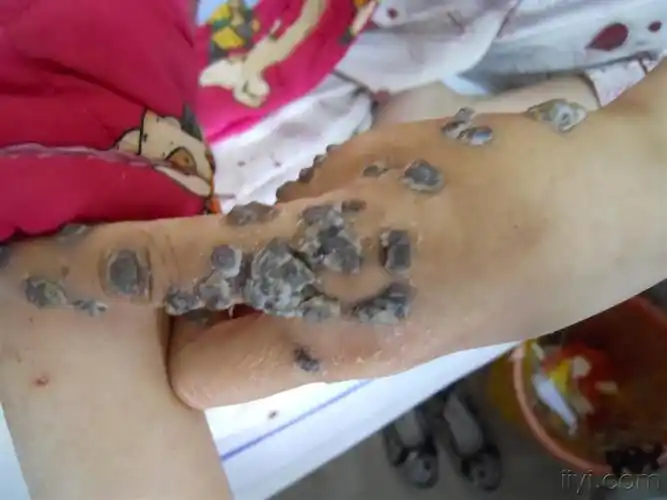 皮肤及性传播疾病讨论版 - 爱爱医医学论坛