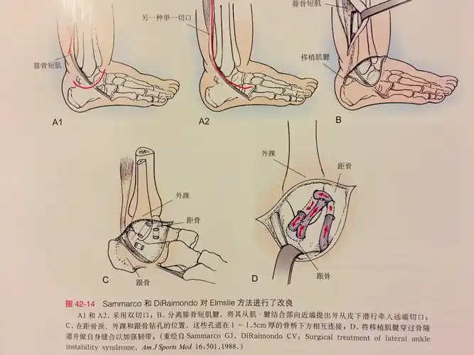 2)eyring术式:将腓骨短肌腱的前半穿过腓骨隧道缝合于距跟骨间韧带,以