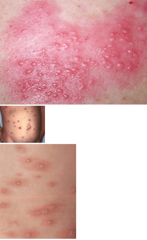 婴儿水痘症状图片及治疗