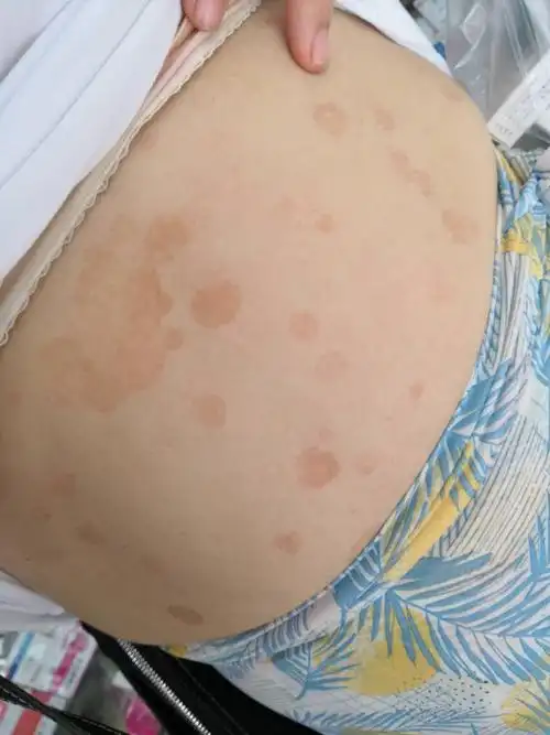 花斑癣,俗称汗斑.