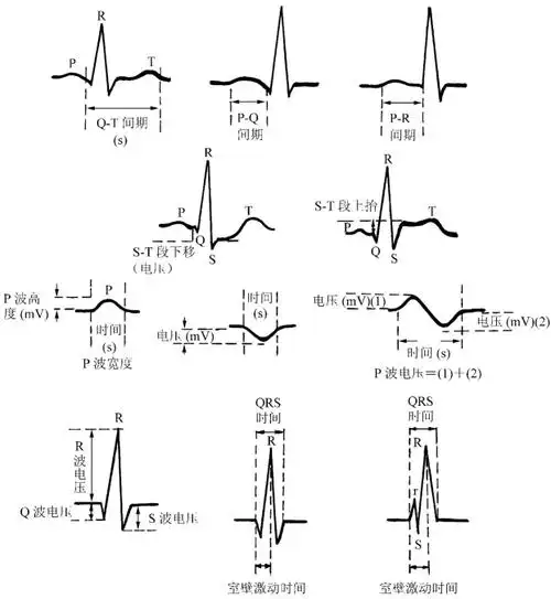 心电轴的测量方法及意义