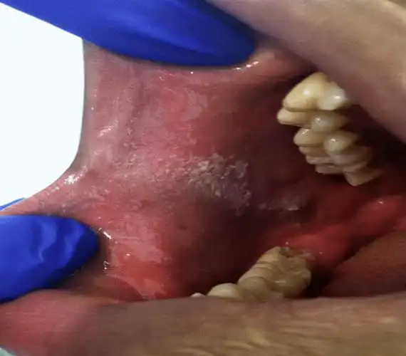 肛门息肉图片(身体5个地方长) - 赤虎壹号