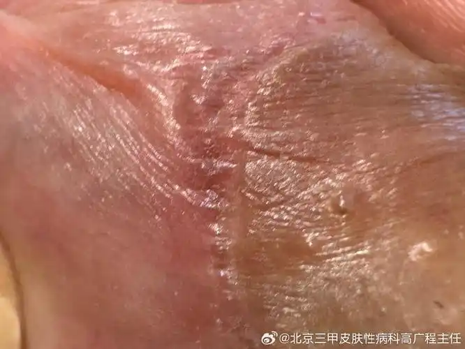 微博医生社区##健闻登顶计划##健康过暑假