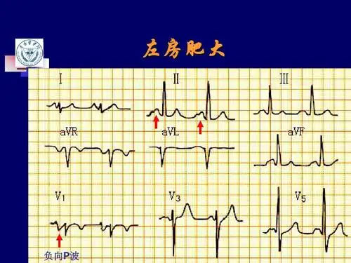 异常心电图检查全部ppt