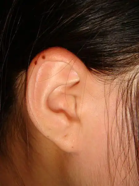 右耳朵长了俩痣好不好?