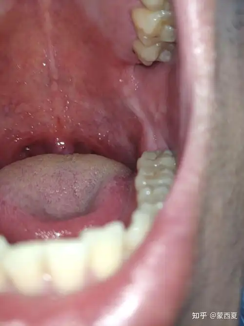 悬雍垂乳头状瘤 自切除