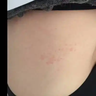 孕5个月了长带状疱疹怎麼办啊?在左腰上.