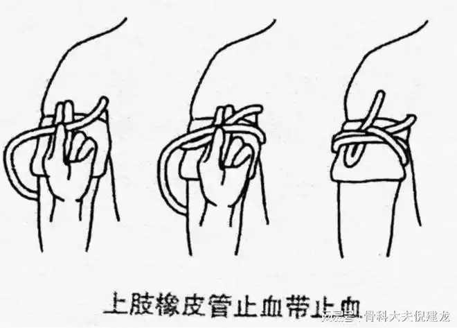 断肢的紧急处理(1)切勿自行接驳当发生手指,脚趾断裂时,曾有伤者用