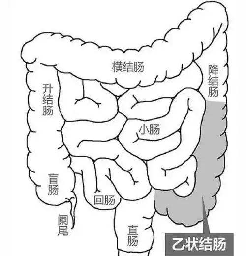老年人突发腹痛如球,需警惕肠扭转