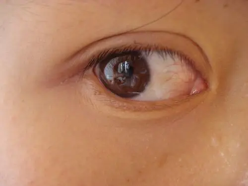 眼睛的眼白处有黄黄的一直都去不掉