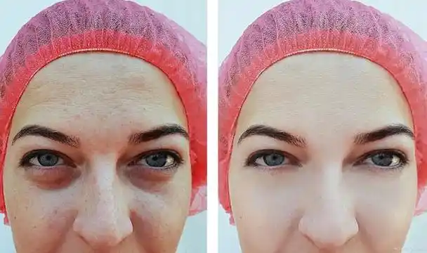 泪沟填充|不同的泪沟怎么挑选填充材料,一起来往下看吧!