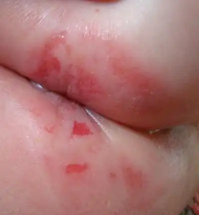 尿布疹图片_尿布疹症状表现图片大全_有来医生