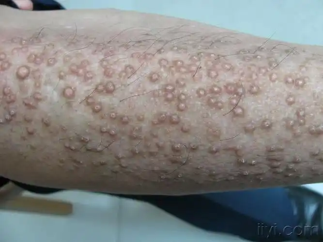 小腿皮疹皮肤淀粉样变