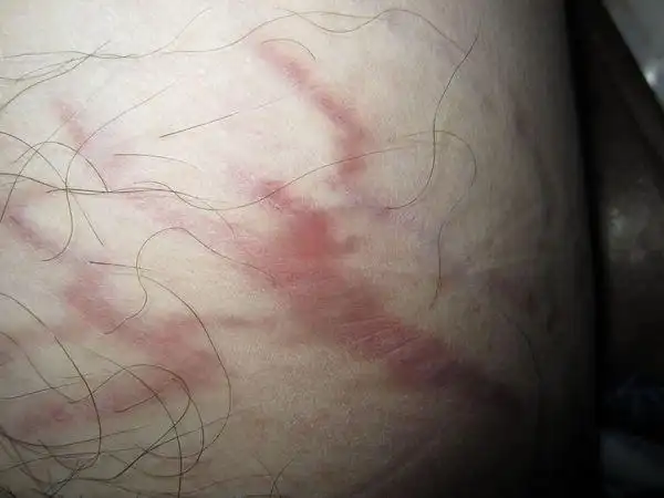 阴囊旁边出现红色斑纹,不痛不痒,有慢慢扩大的趋势.不知道得了什么病?