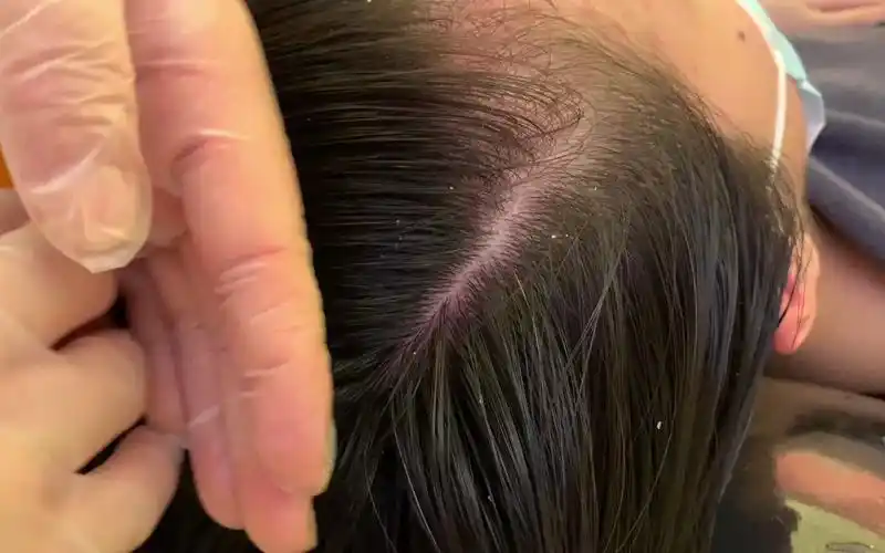 怀孕准妈妈头皮敏感发红晚上痒得睡不好觉头屑都成硬壳