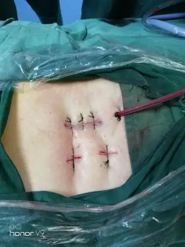 首例(mis_tilf)经皮微创治疗腰椎滑脱病例