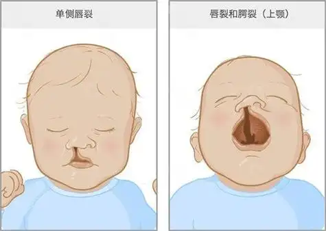 2022全国唇腭裂医院排名一览,含唇腭裂修复好的医生及价格