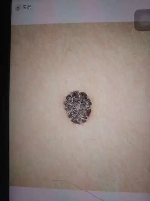 黑色痣问诊20190113