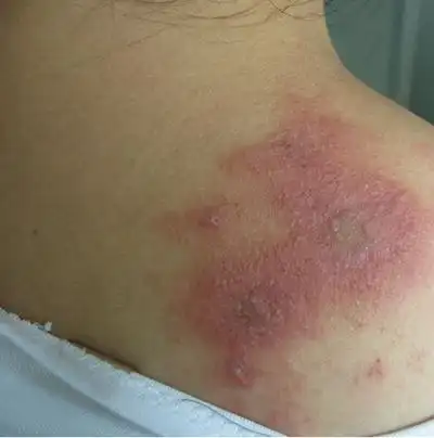 虫咬性皮炎图片 (109)_有来医生