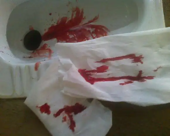 痔疮便血该怎么办?有没有快速的方法