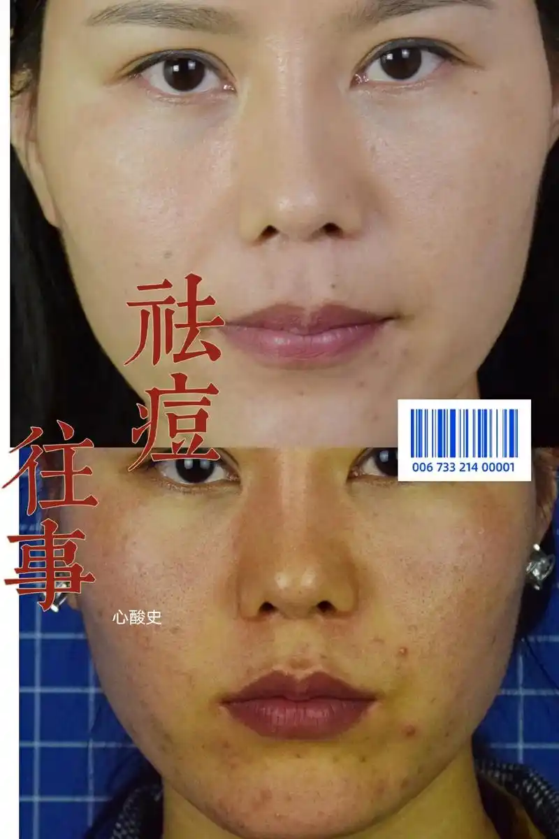 黄金微针祛痘史#问题性皮肤管理 #轻松拥有好皮肤 #让我们一 - 抖音