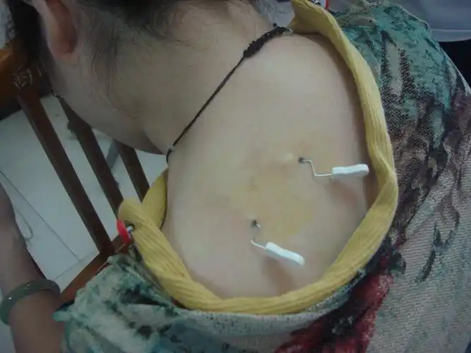 儿童腿部坏死性筋膜炎图片_有来医生