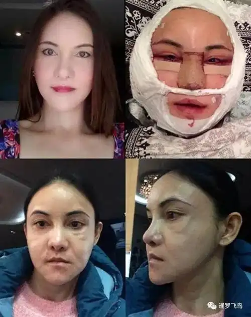 泰国女艺人韩国整容变毁容 发文警醒手术变美靠运气