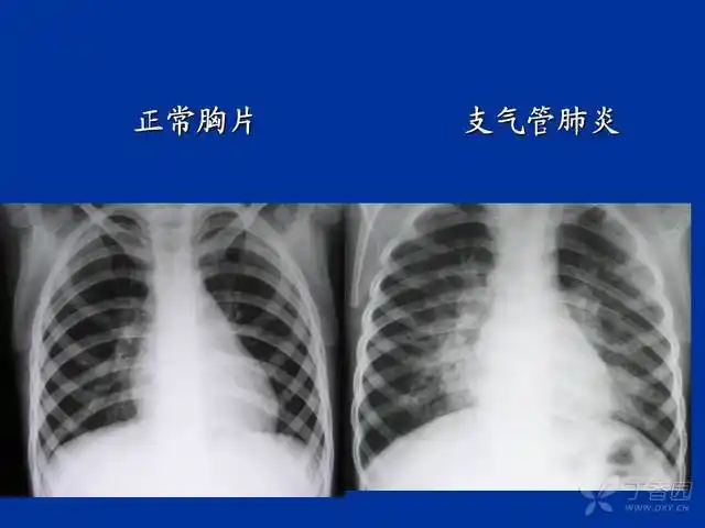 小儿肺炎的治疗