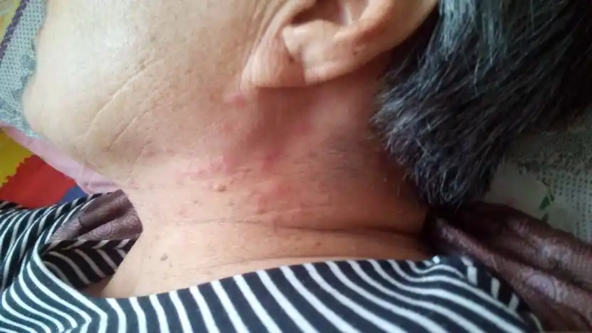 老人73岁,昨天脖子上起了一片小红疙瘩,而且很痒