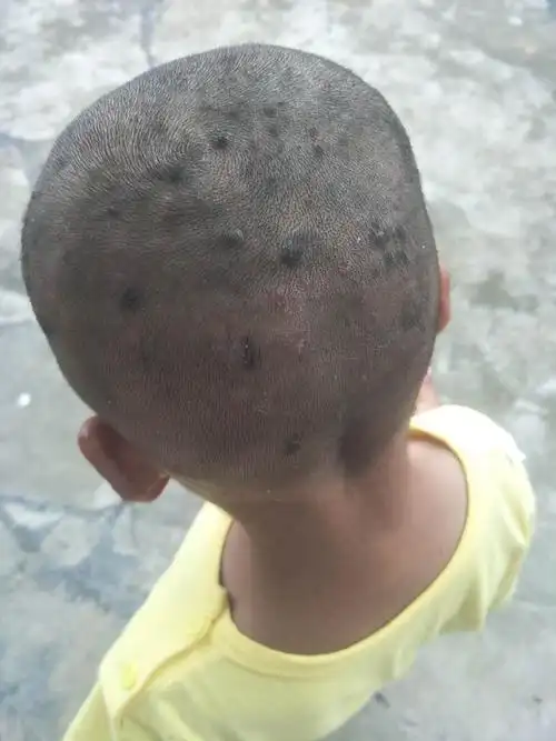 小孩子头上长好多包,怎么治