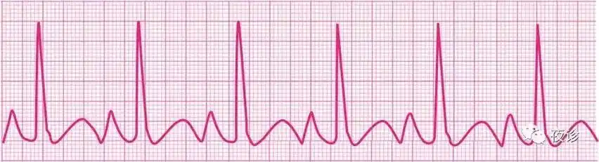 异常p波的心电图特点