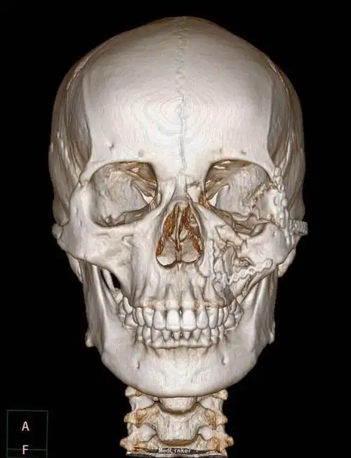 左侧颌面部骨折