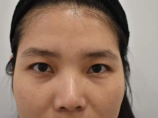 玻尿酸填充泪沟案例整形医生案例大赏