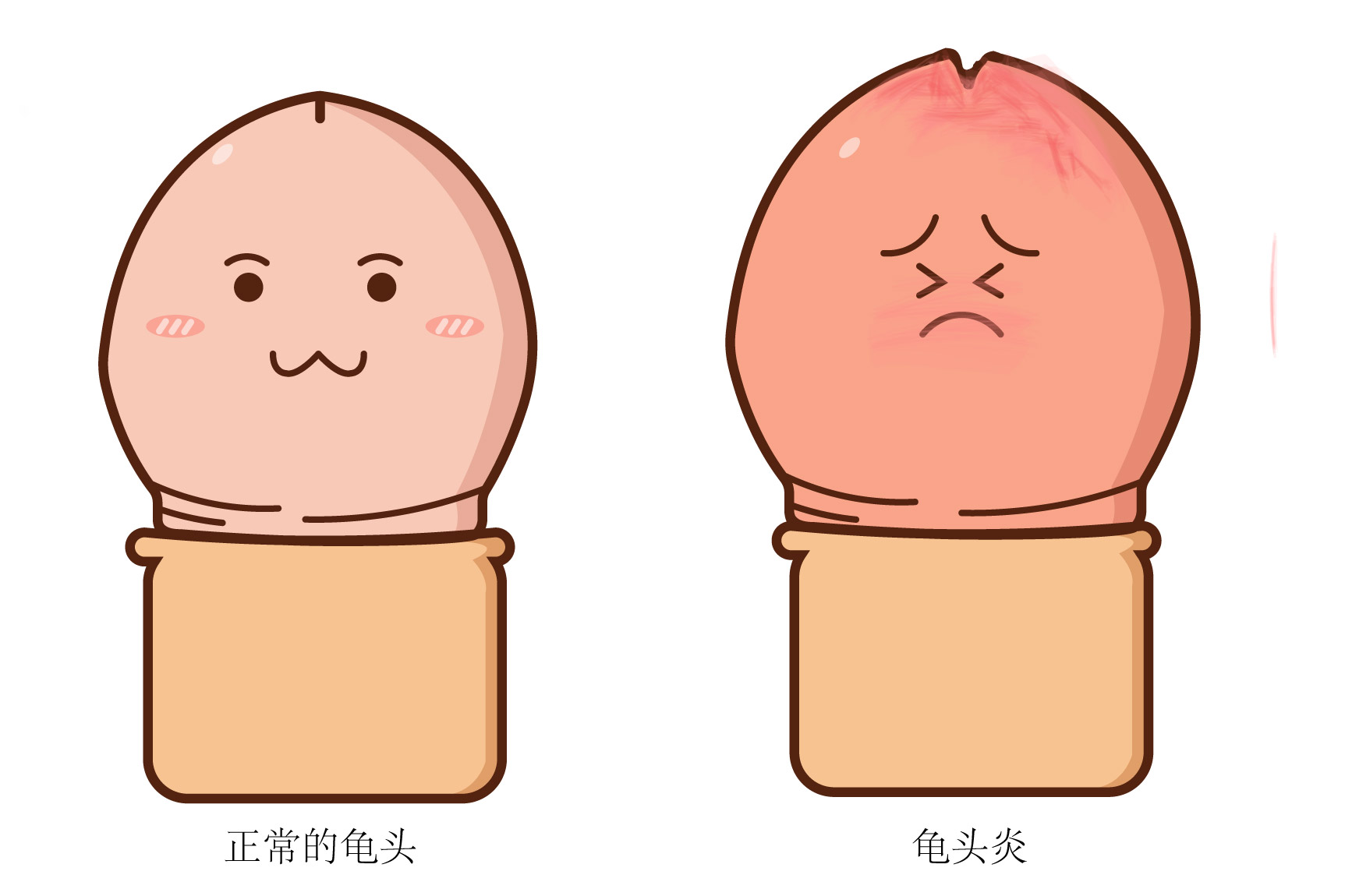 尿道口红肿外翻多数是由于包皮龟头炎引起的,可在医生的指导下口服