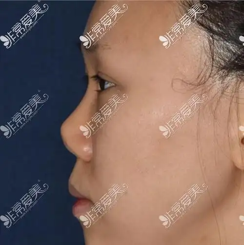 鼻头长度不够,导致鼻尖后缩,鼻孔朝天,不管正面看还是上面的侧面图,对