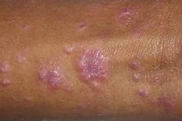 男梅毒初期图片40