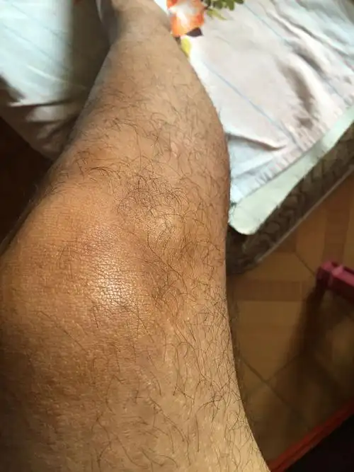 走时间长了膝盖右边鼓出来一个包,疼,平时一点也不痛,去医院检查说是
