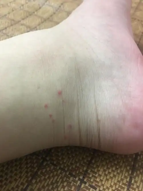 脚上红点怎么回事?