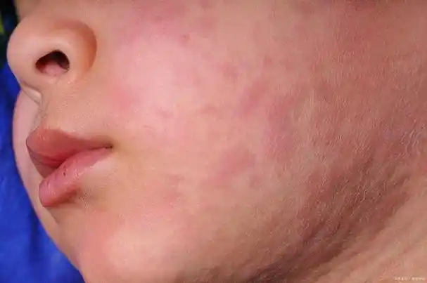 孩子脸过敏红肿痒怎么办?