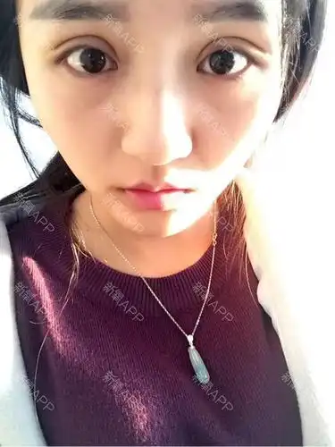 我在清木做的生态双眼皮第5天,8毫米的,我咋感觉这么宽啊,你们