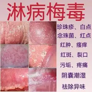 治疗淋病性病一扫光包皮炎龟头炎梅毒男女性病克星喷剂私处药膏