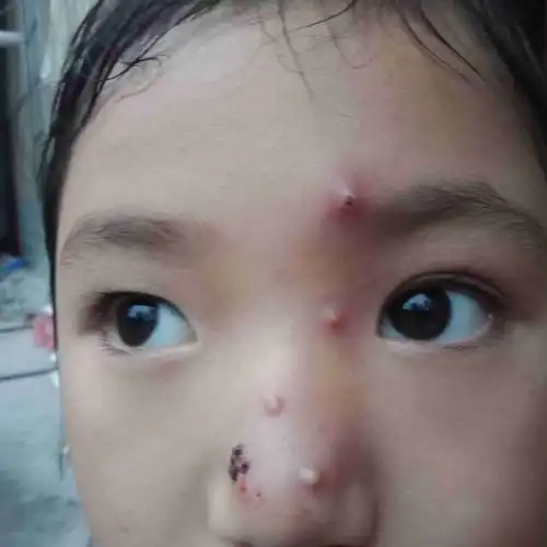 5岁小孩脸上长小红疙瘩