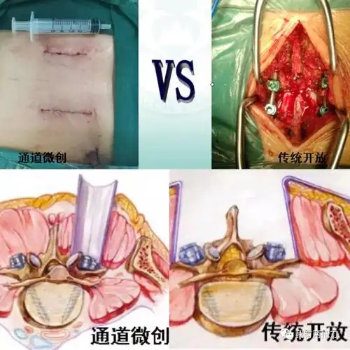 腰椎手术,无"微"不至!微创通道技术介绍