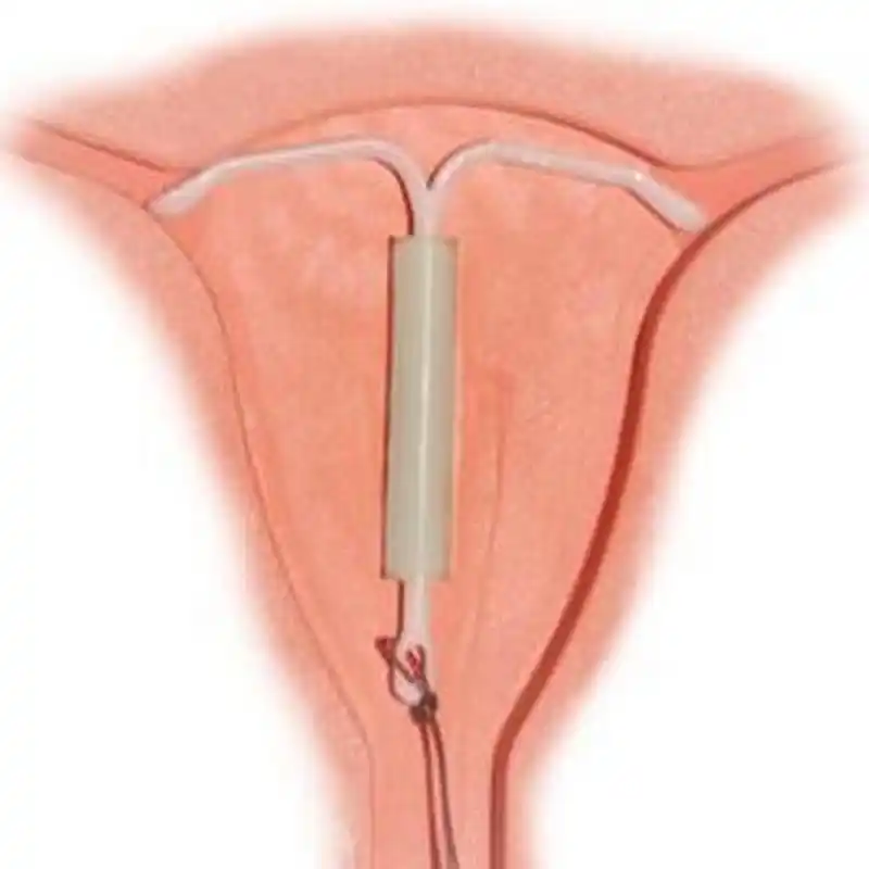 上曼月乐环前,这三点应该先了解#腺肌症#  得了腺肌症的姐妹都想上