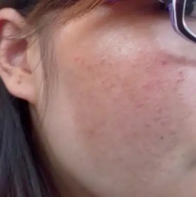 我脸上有大片黑色素沉淀,已经好几年了,不知道怎么去除,看过很多医生