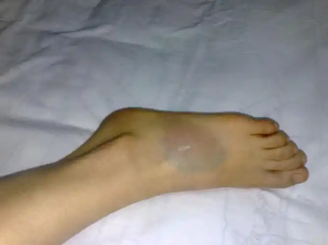 踝关节|习惯性|崴脚|扭伤|脚踝|运动|-健康界