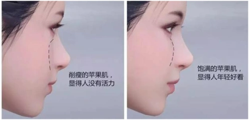 苹果肌凹陷,下垂该怎么解决?_注射美容 - 好大夫在线