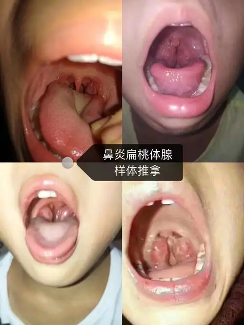 中班大班的小朋友,腺样体肥大扁桃体肿大